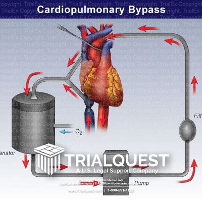 centrifugal pump in cardiopulmonary bypass|cardiopulmonary bypass procedure steps.